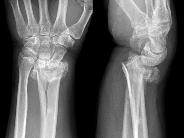 Перелом лучевой кости запястья на рентгене