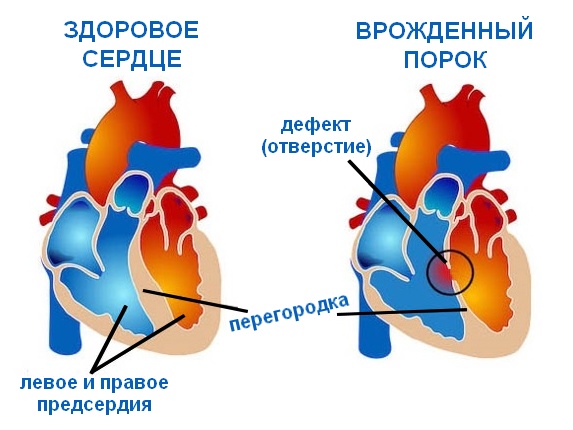 Здоровое сердце и врожденный порок сердца